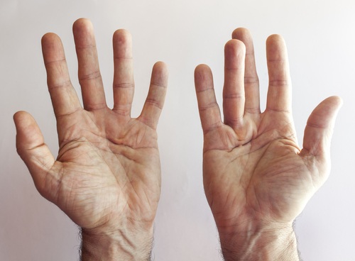 Hands of a man with Dupuytren's Contracture Disease against a bright background.